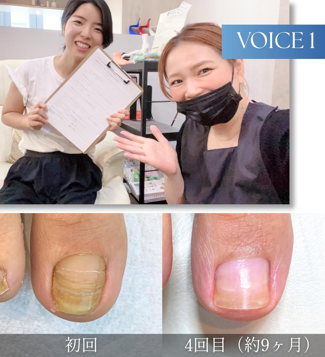 変形爪・段差で悩んでいたお客様の声1